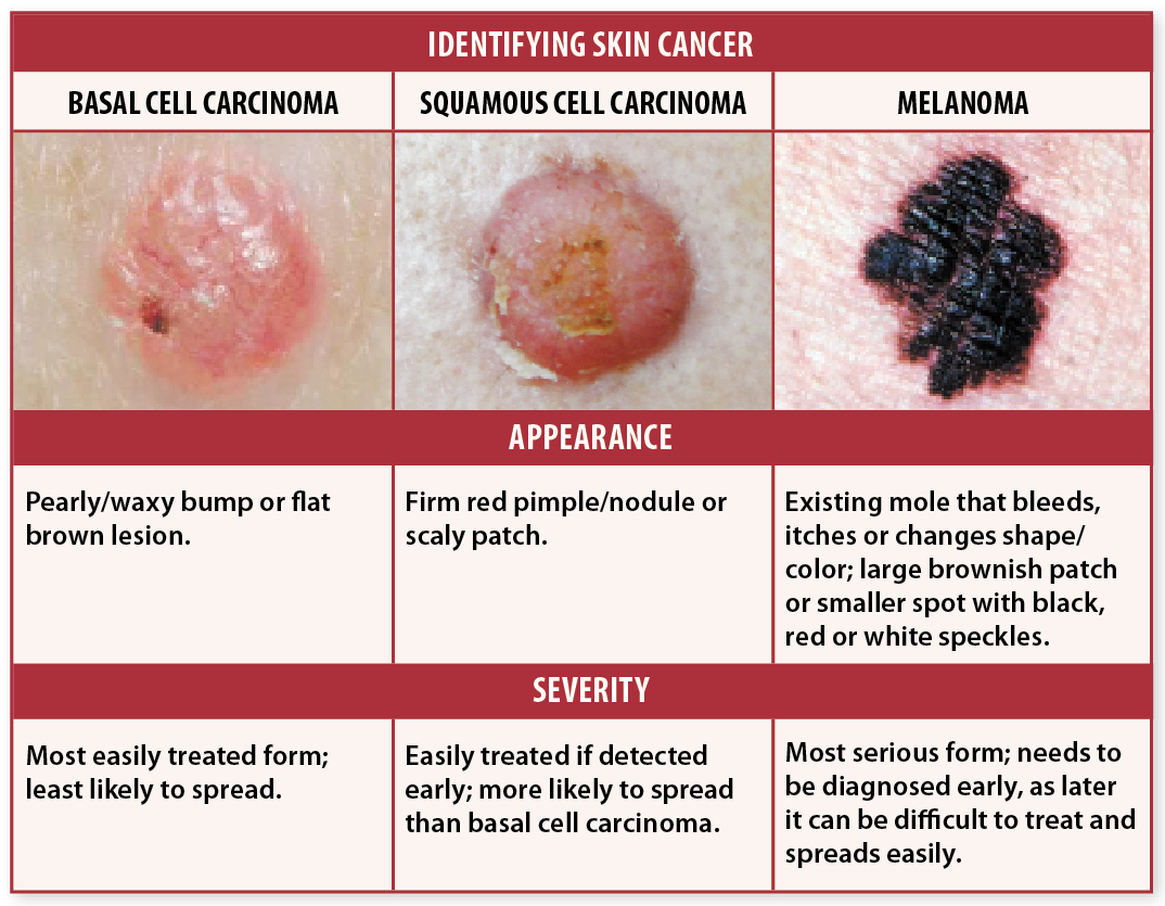 3 Types Of Skin Cancer Cells